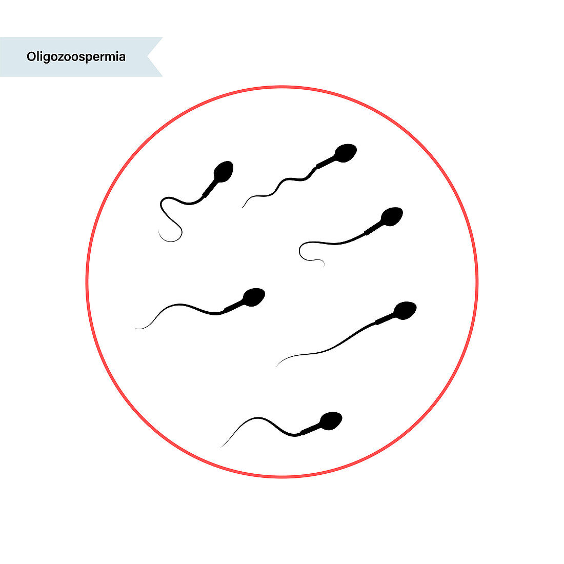 Abnormal sperm, illustration