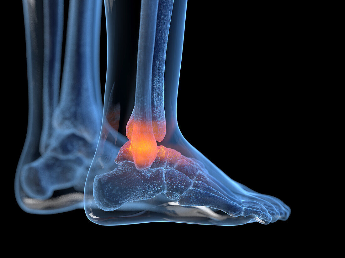 Inflamed ankle, illustration