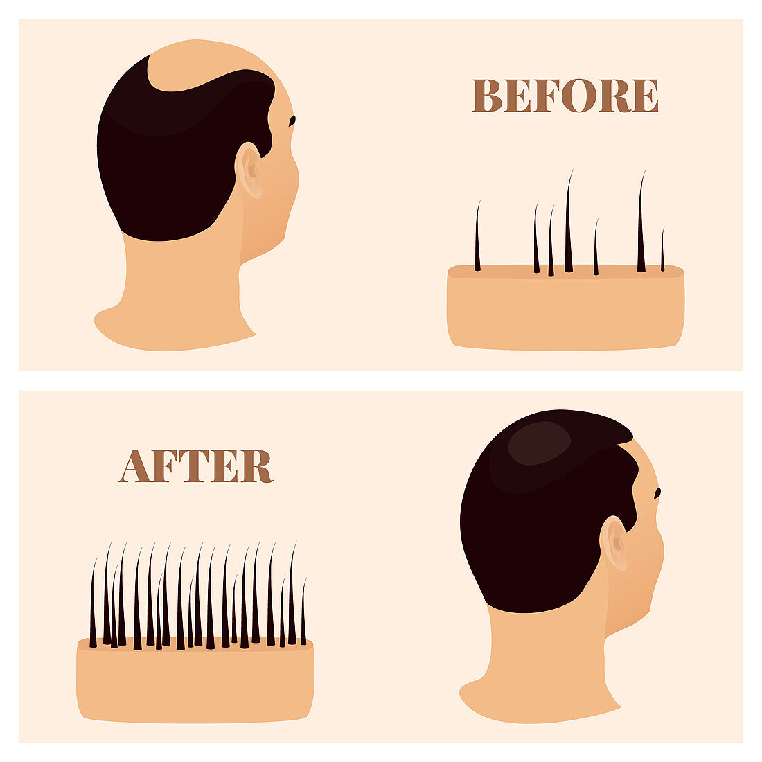 Hair loss treatment, conceptual illustration