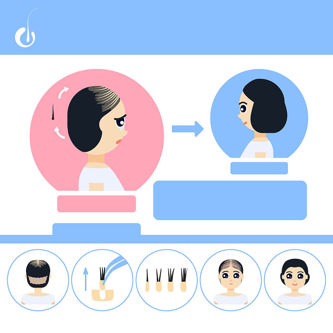 FUE hair transplantation in women, illustration