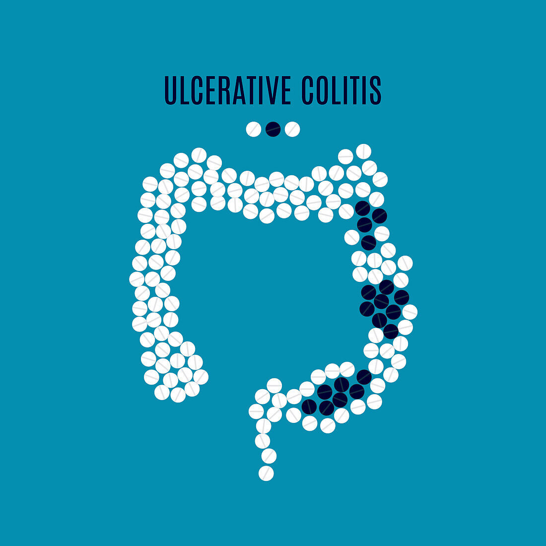 Ulcerative colitis, conceptual illustration