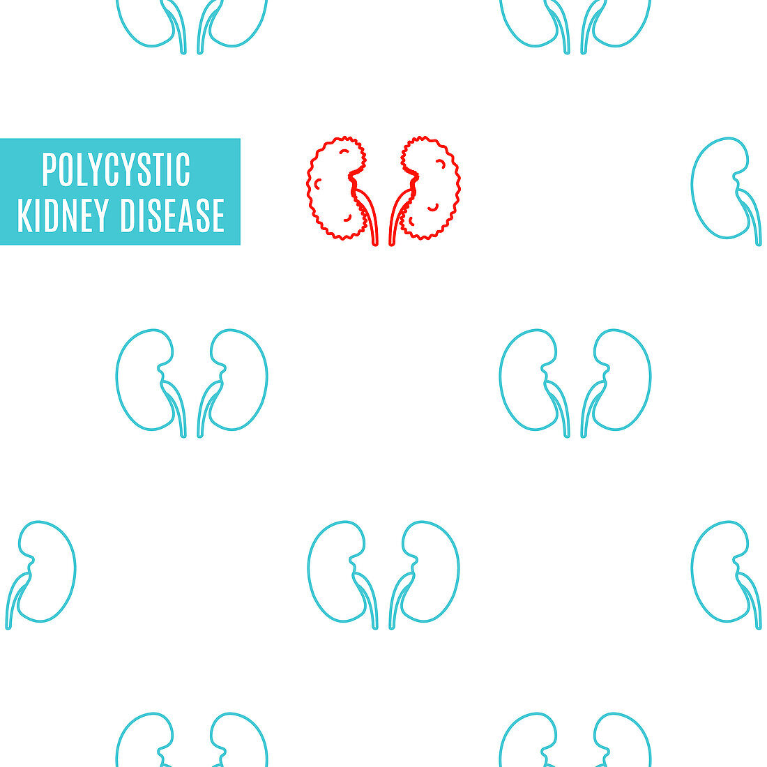 Polycystic kidney disease, conceptual illustration
