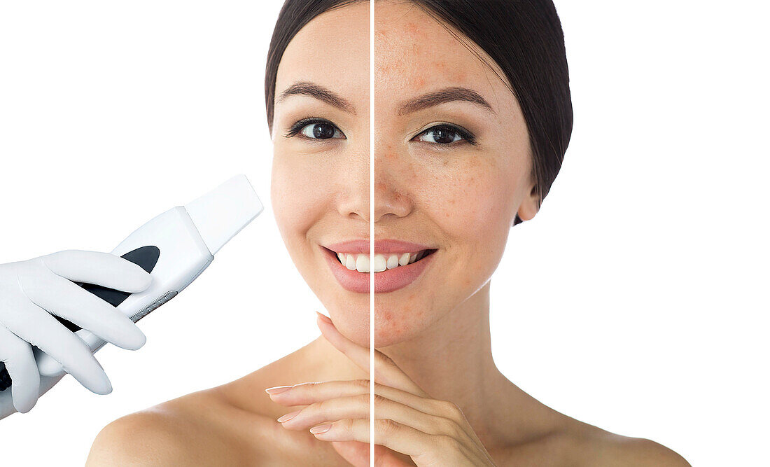 Ultrasonic face peel before and after