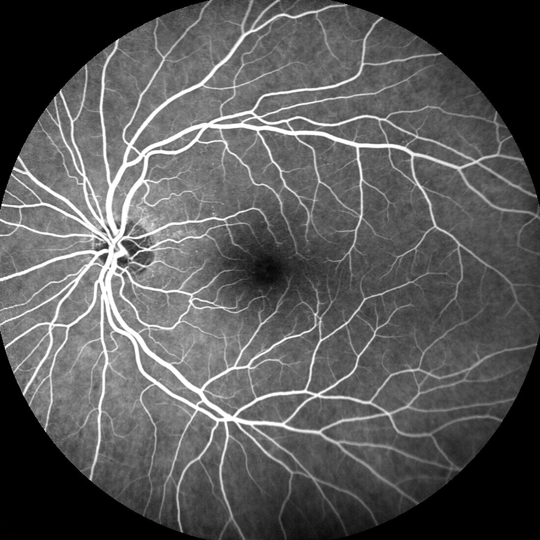 Healthy eye, angiogram