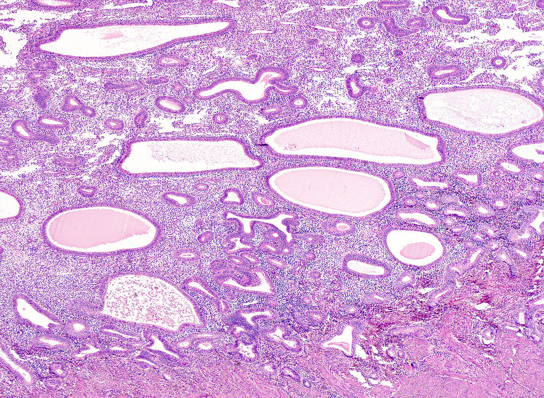 Nonatypical endometrial hyperplasia, light micrograph
