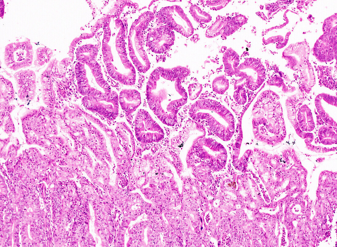 Endometrioid carcinoma, light micrograph