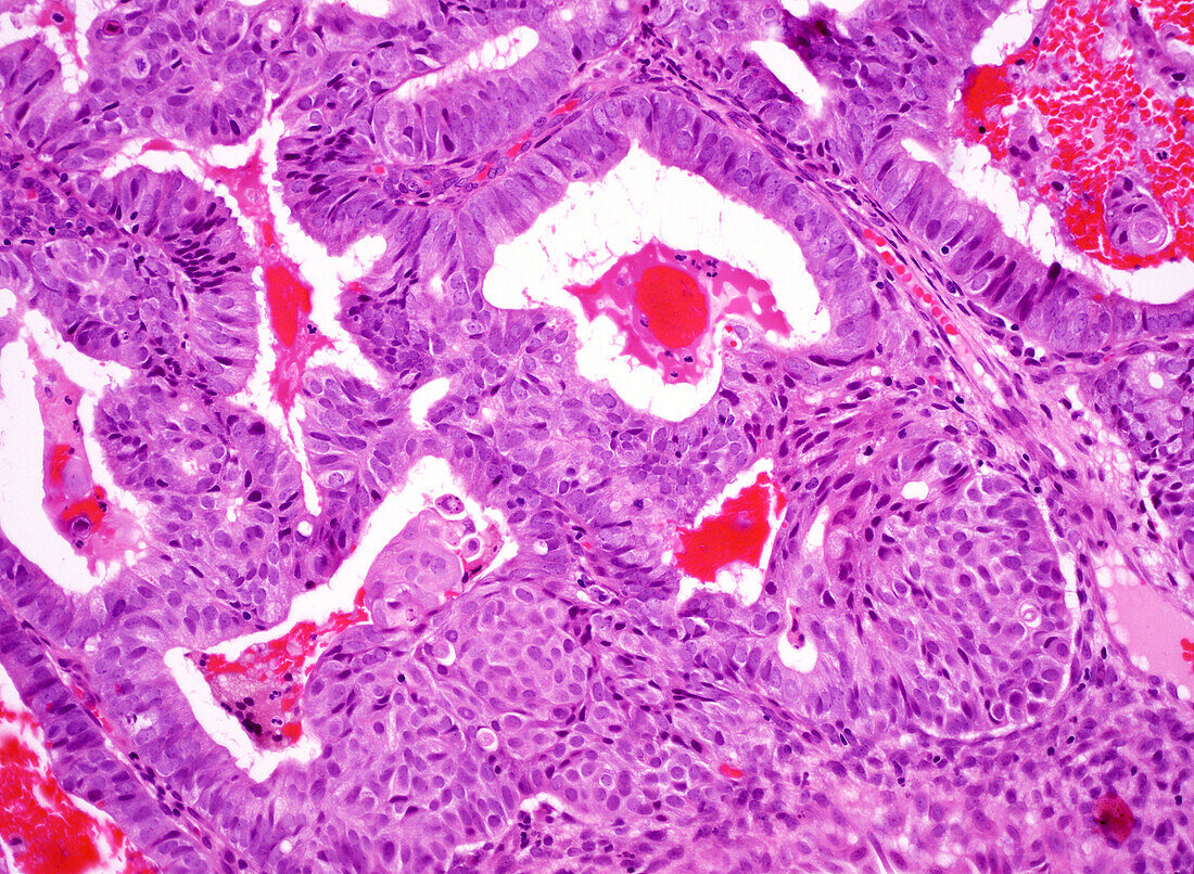 Endometrioid carcinoma, light micrograph