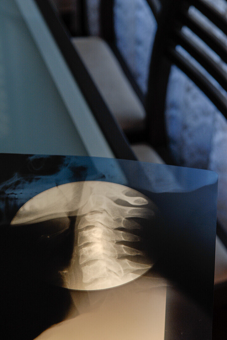 X-ray of a man's neck on a doctor's table
