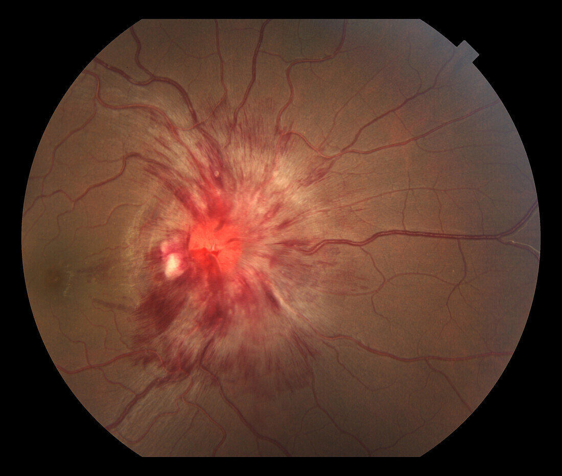 Papilloedema, fundoscopy