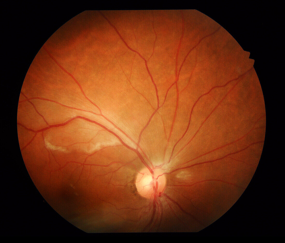 Retinal vasculitis, fundoscopy