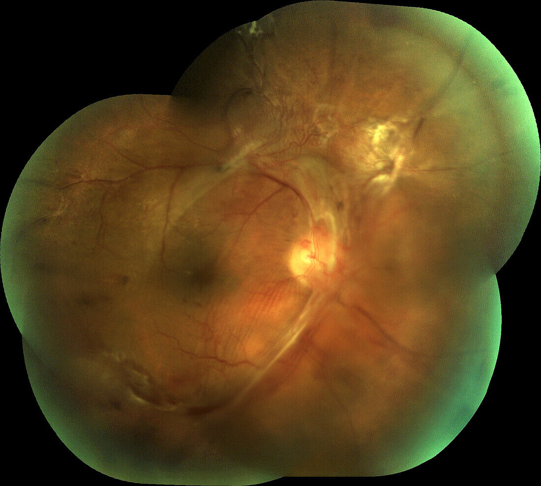 Retina damage from diabetes, fundoscopy