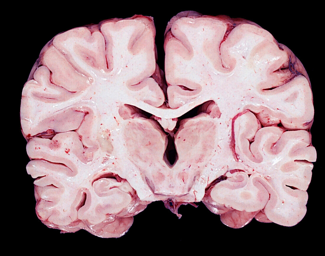 Human brain, gross specimen