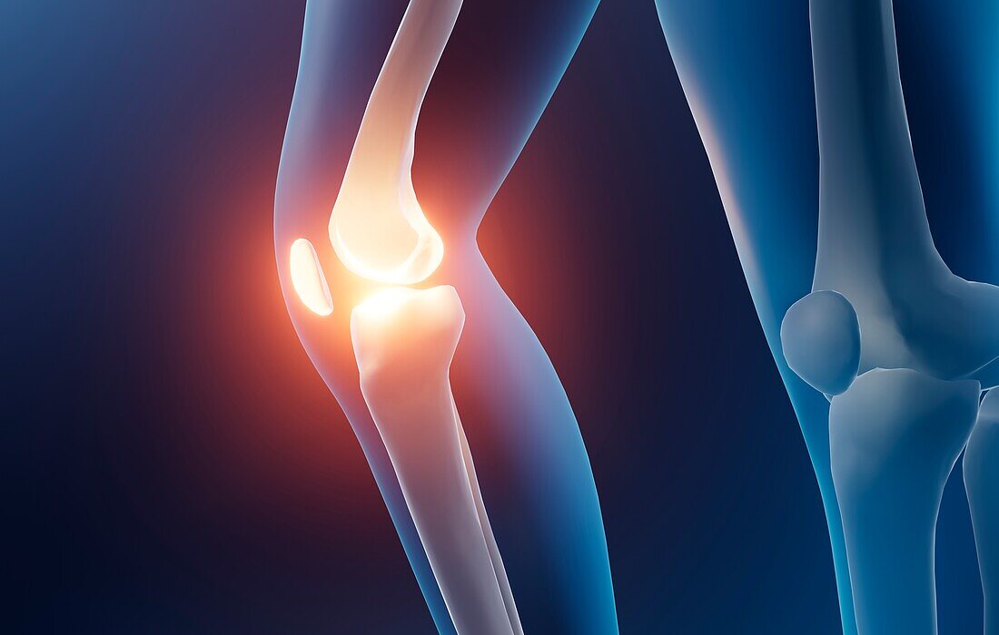 Knee arthritis, illustration