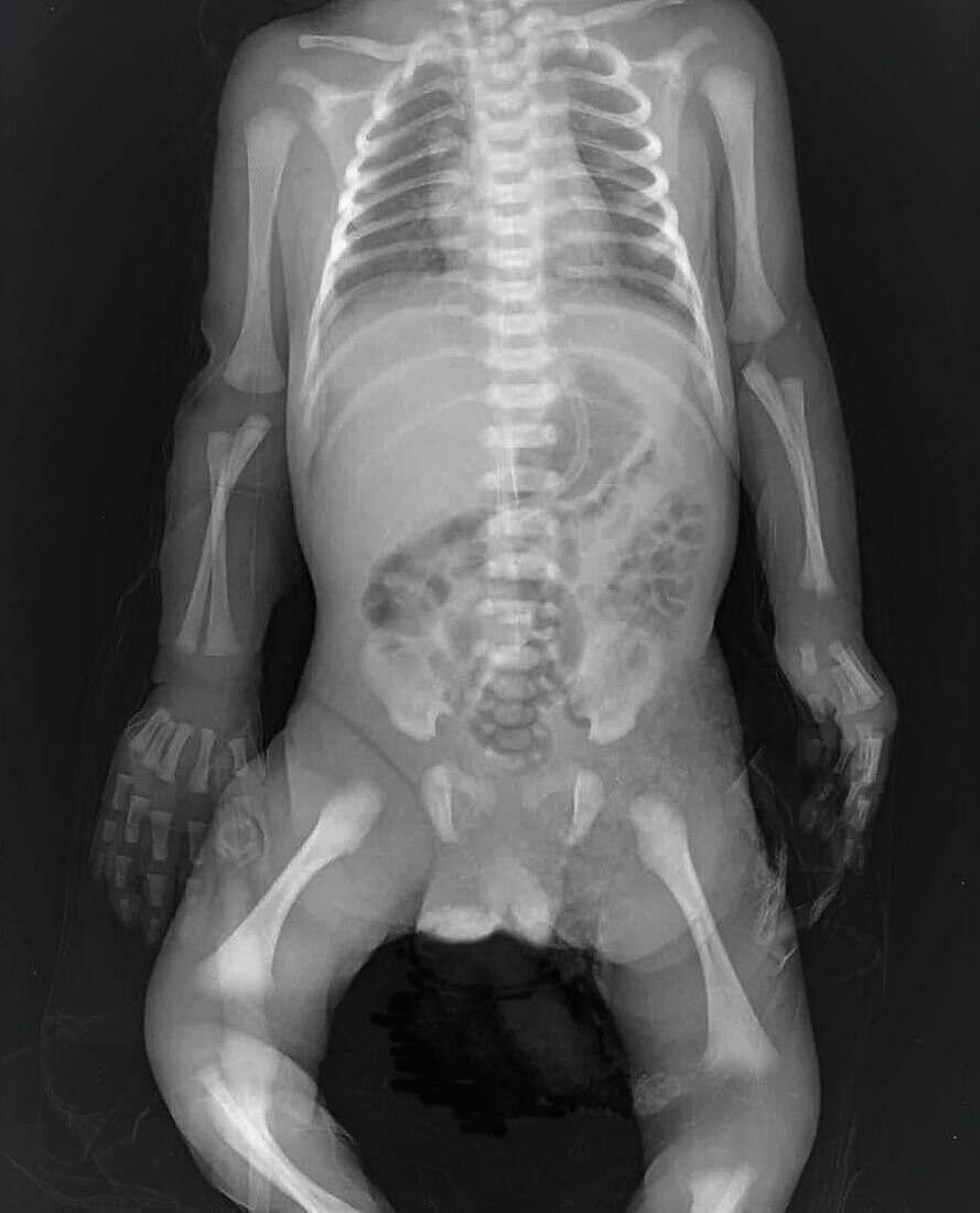 One day old baby, X-ray