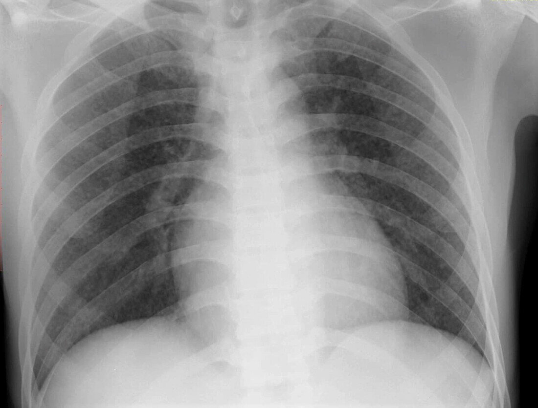 Miliary nodules, X-ray