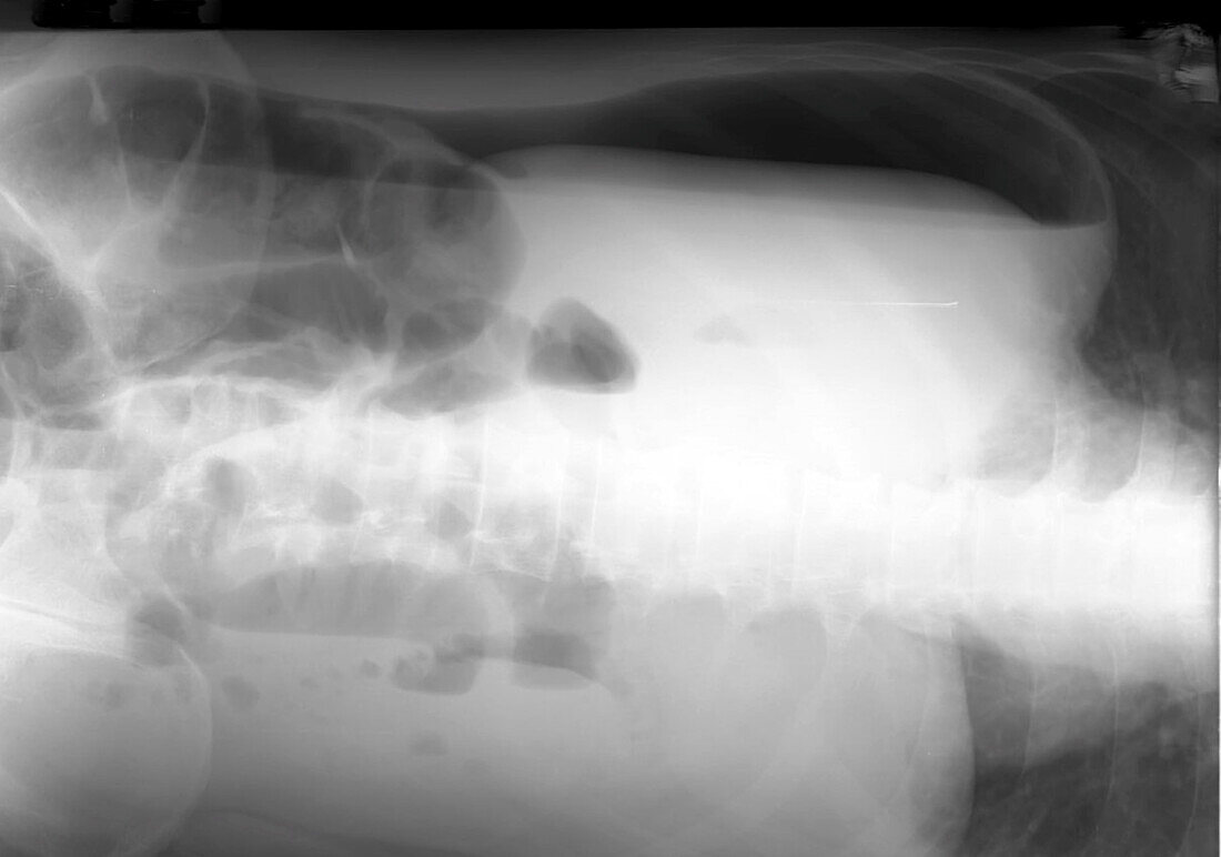 Pneumoperitoneum, X-ray