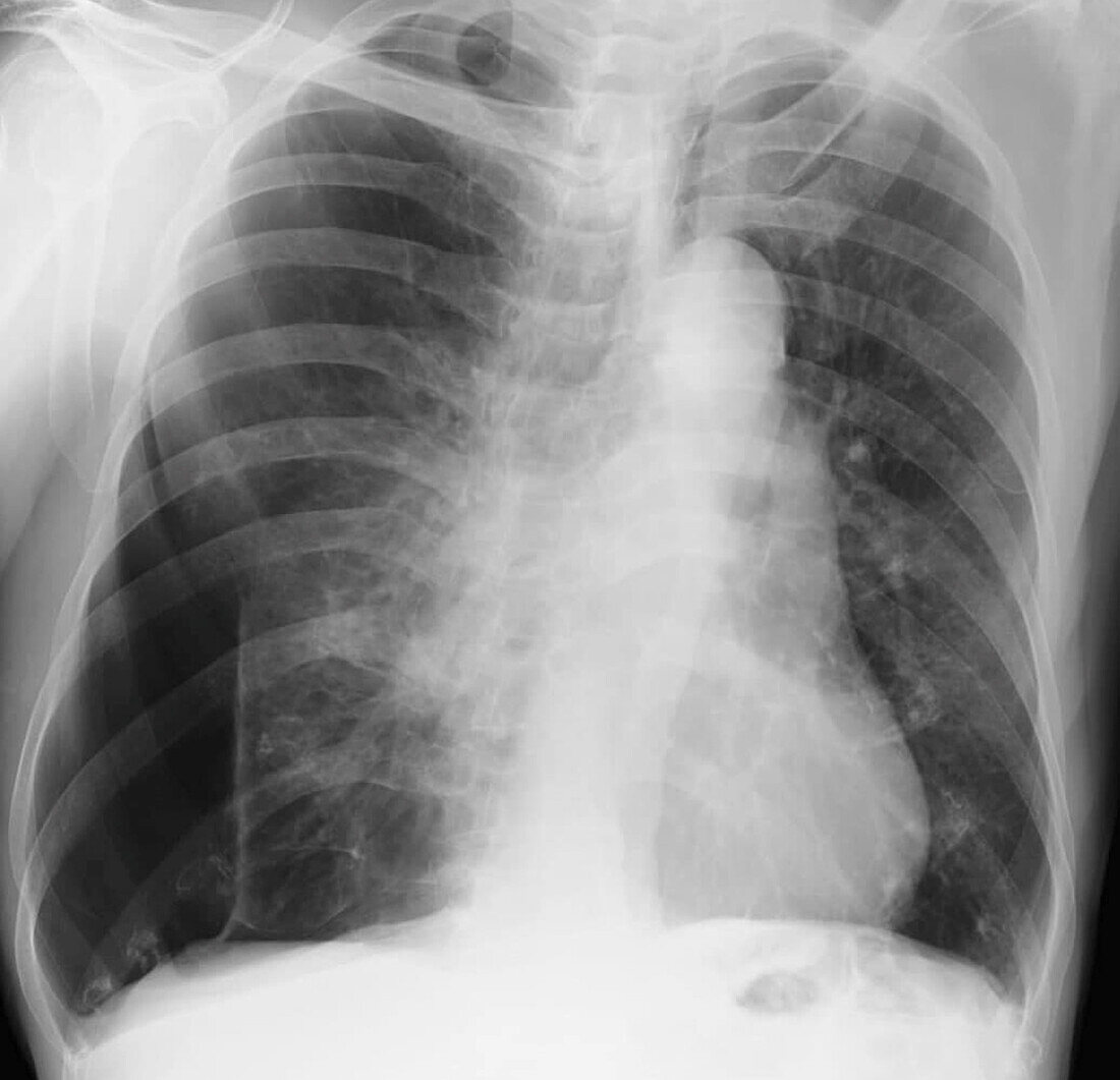 Pneumothorax, X-ray