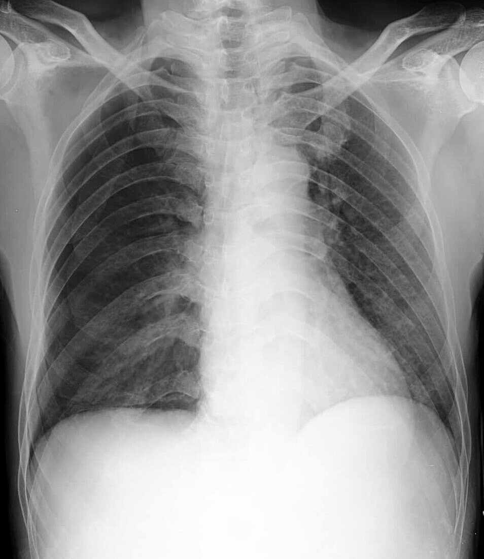 Pneumothorax, X-ray