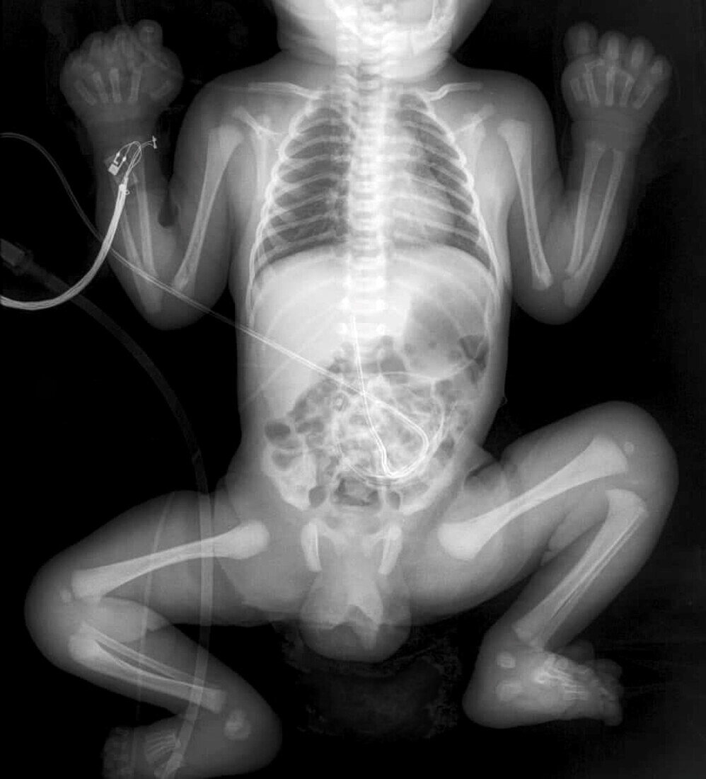 One day old baby, X-ray