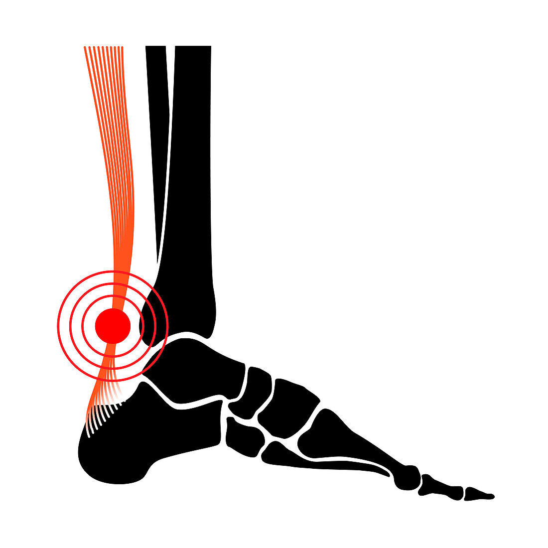 Achilles tendon injury, illustration