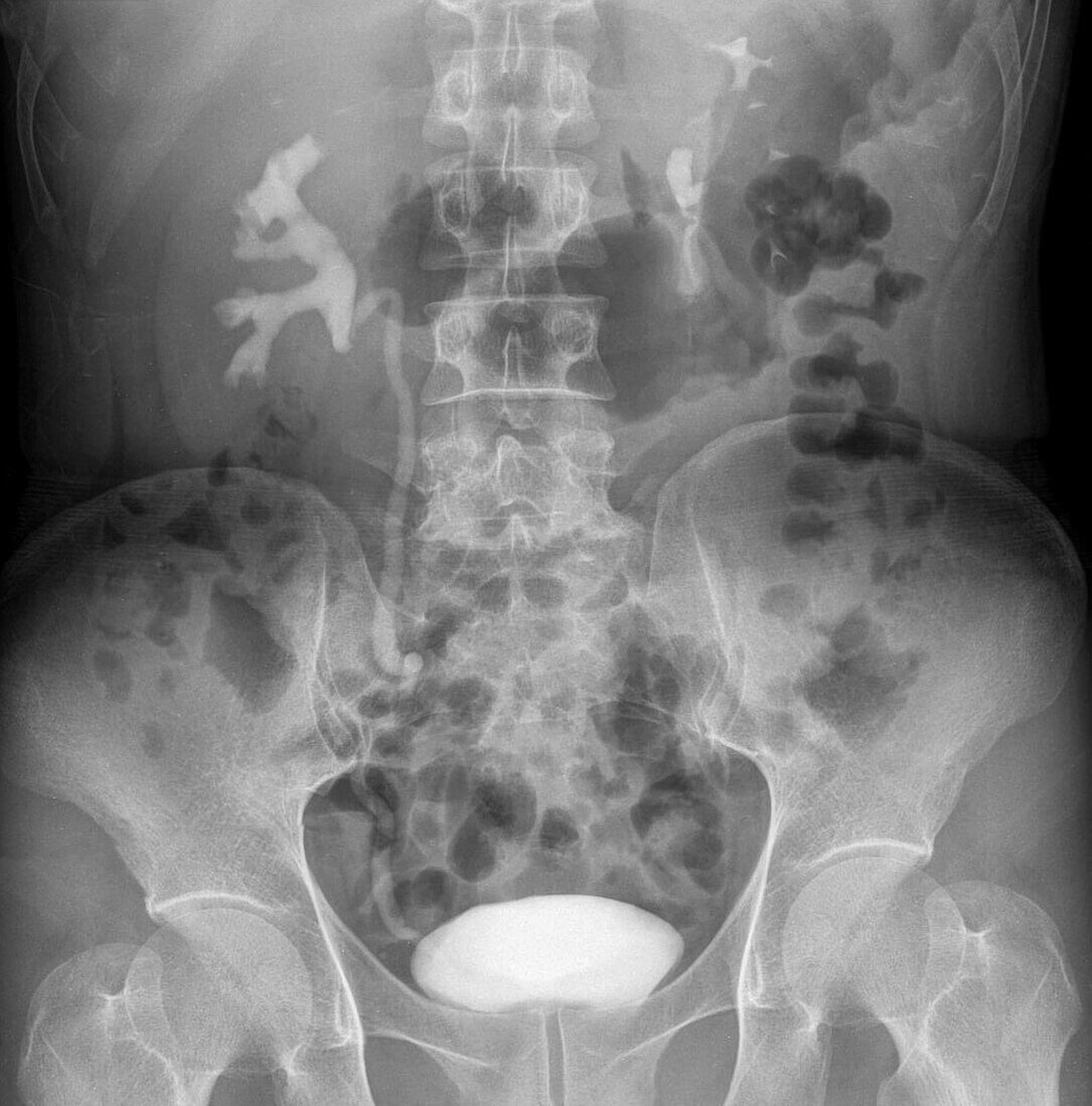 Swollen kidney, X-ray