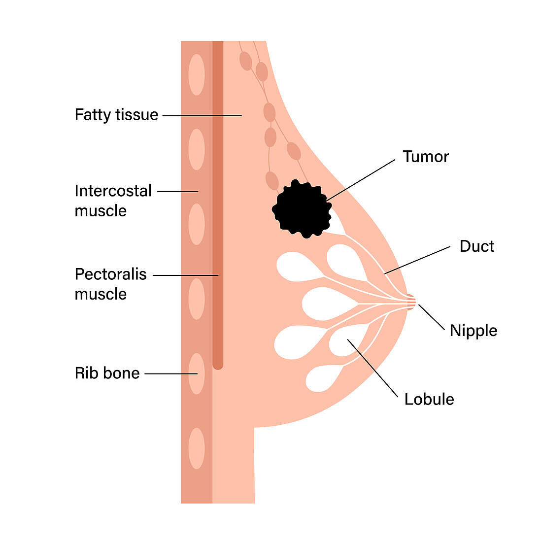 Female breast cancer, illustration