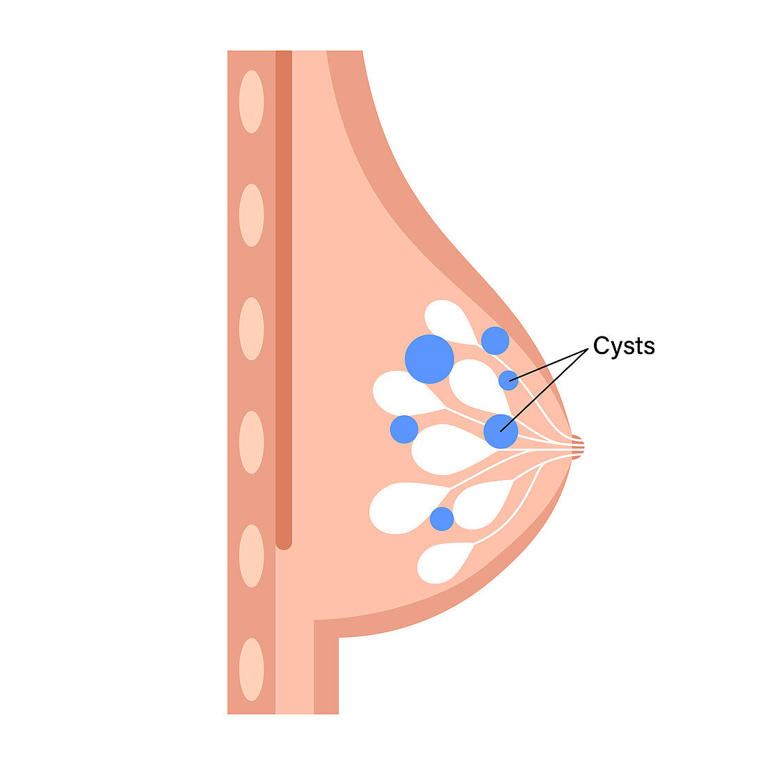 Fibrocystic breast disease, illustration