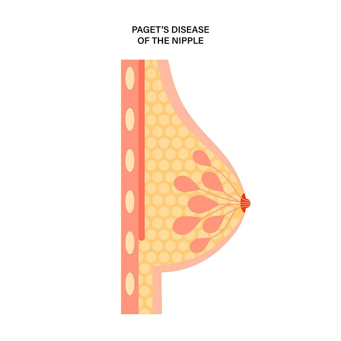 Paget's disease of the nipple, illustration