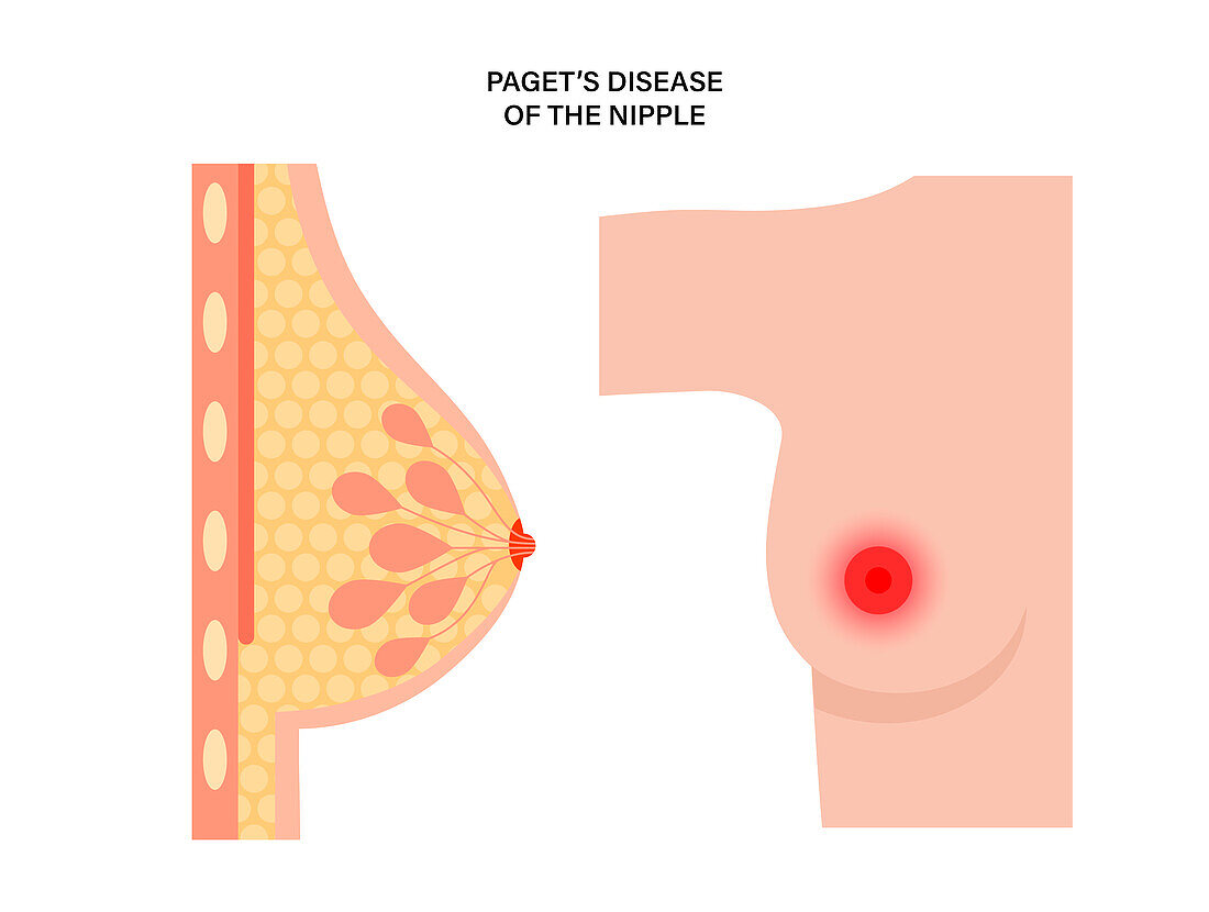 Paget's disease of the nipple, illustration