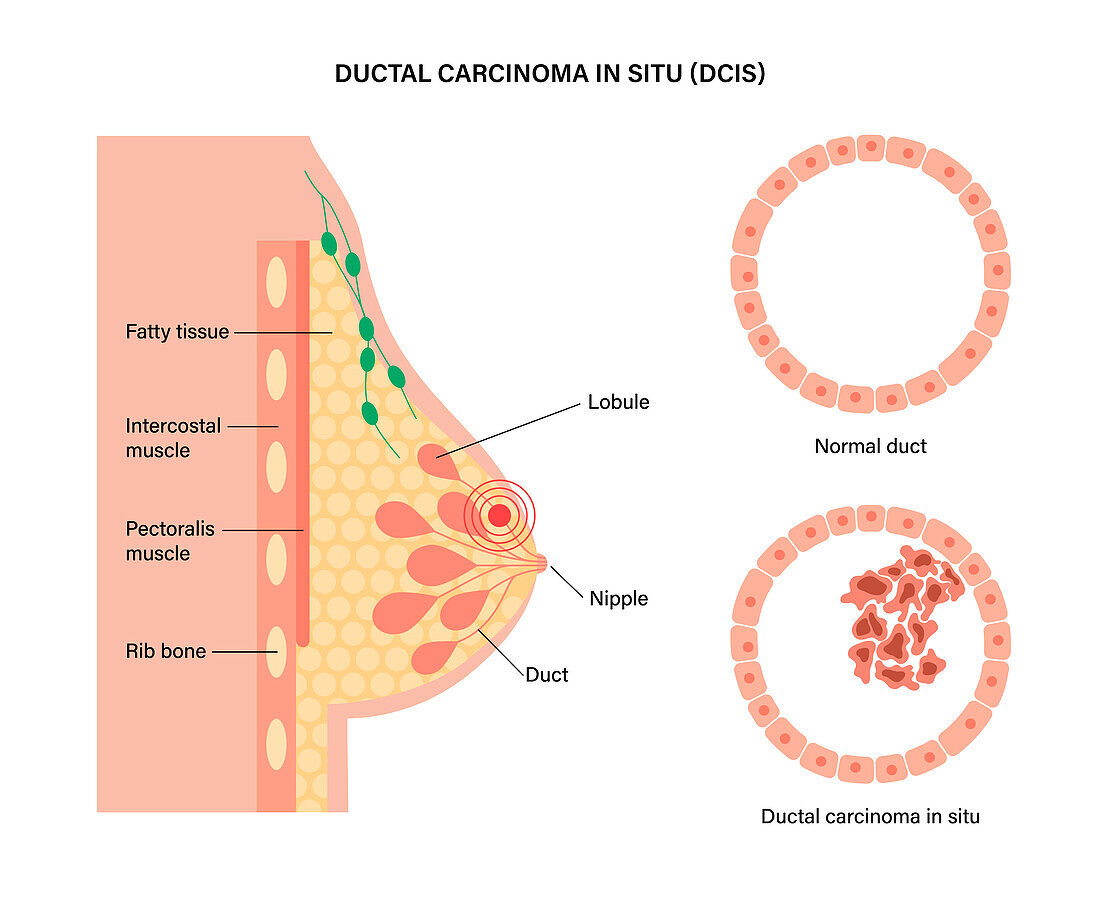 Ductal carcinoma in situ, illustration