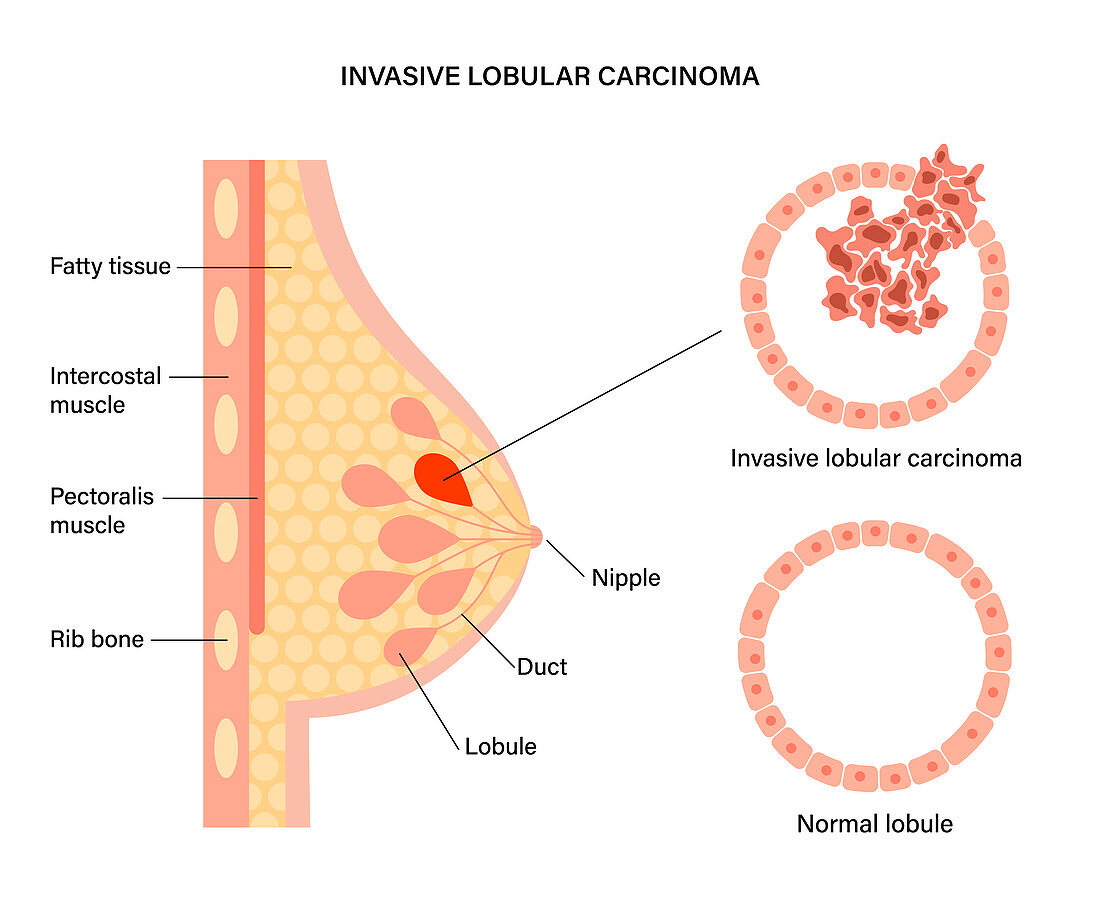 Invasive lobular carcinoma and normal lobule, illustration