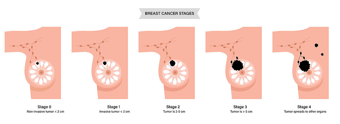 Breast cancer stages, illustration