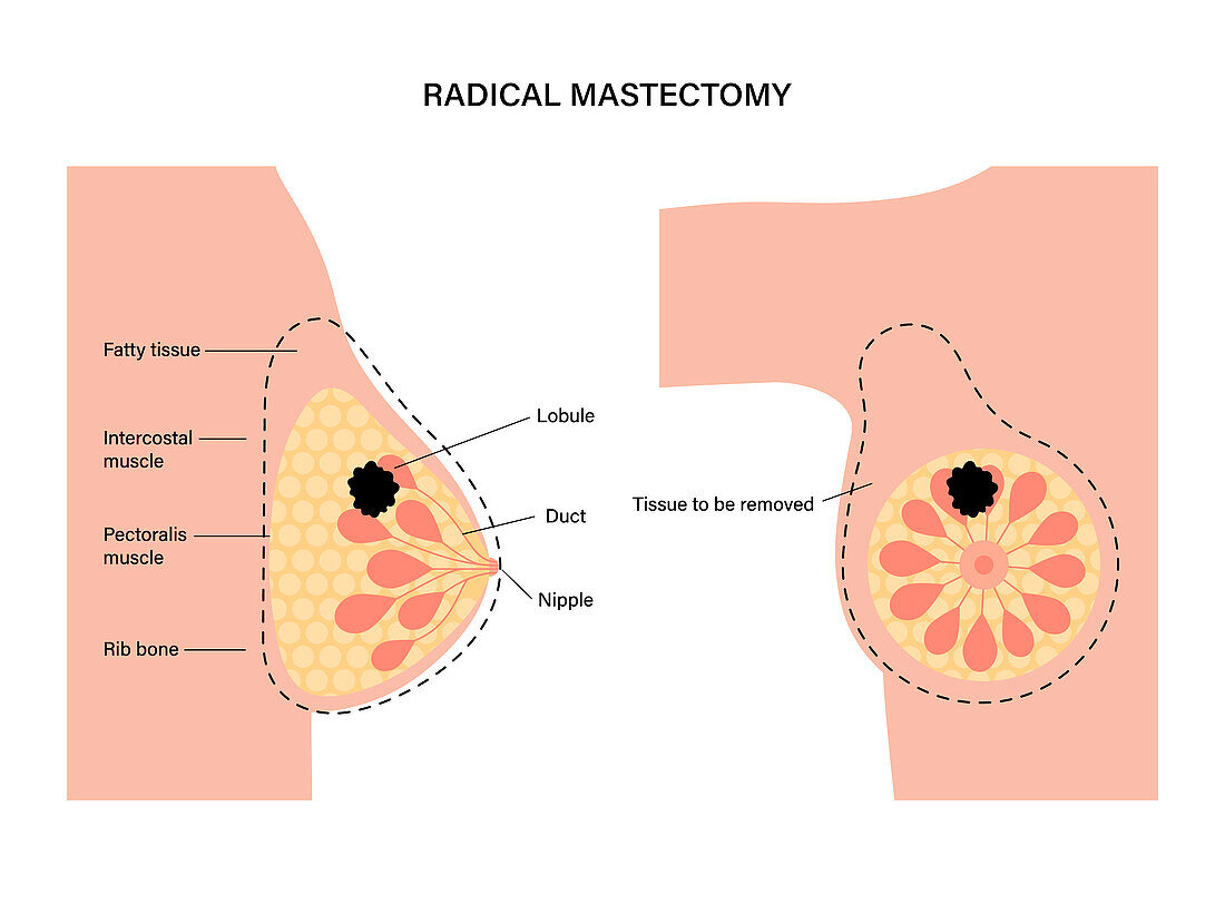 Female radical mastectomy, illustration