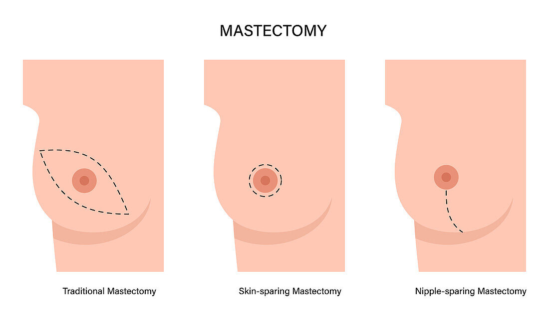 Types of female mastectomy, illustration