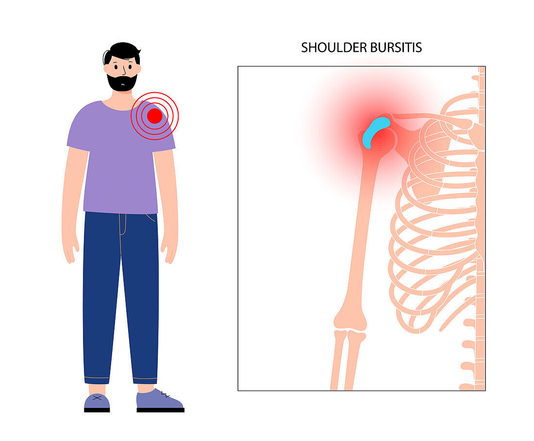 Shoulder bursitis, conceptual illustration