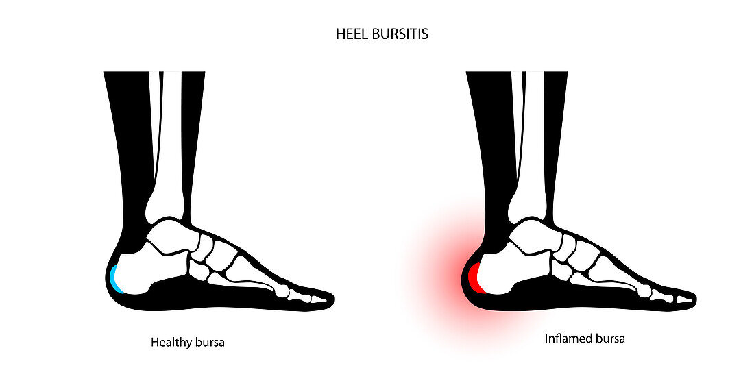 Heel bursitis, conceptual illustration