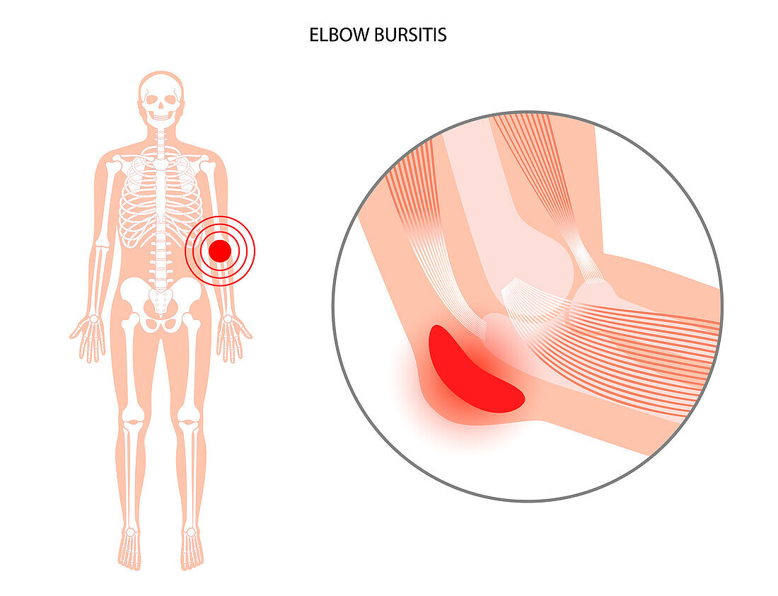 Elbow bursitis, illustration