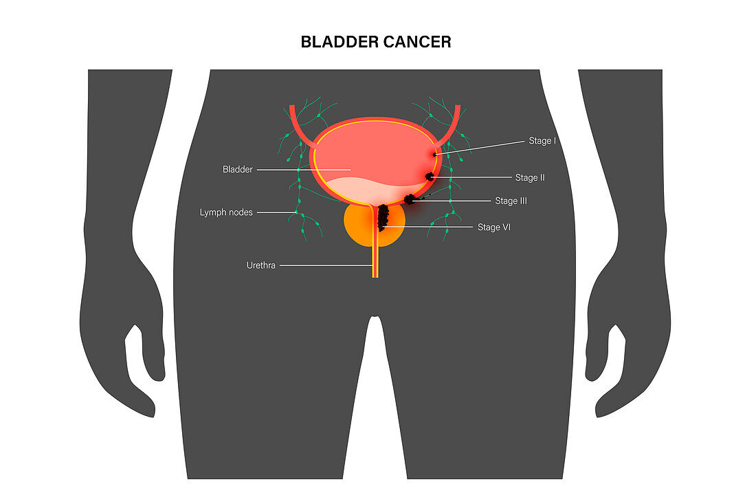 Bladder cancer stages, illustration