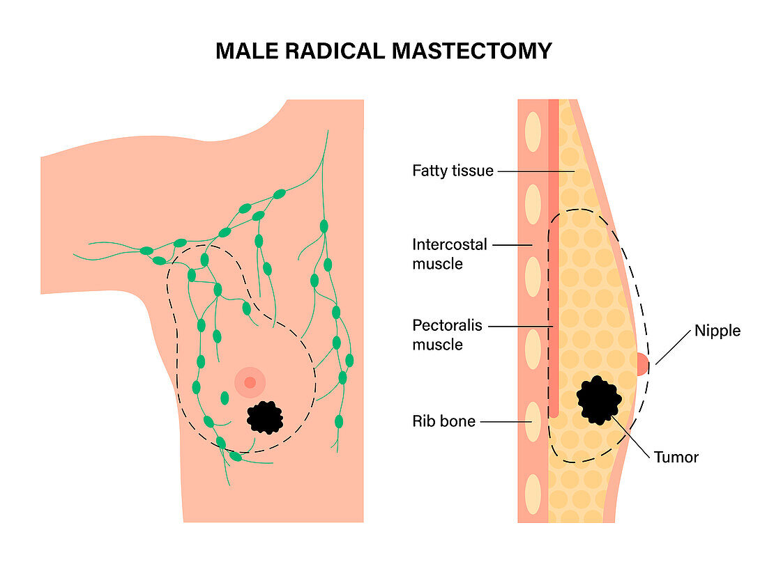 Male radical mastectomy, illustration