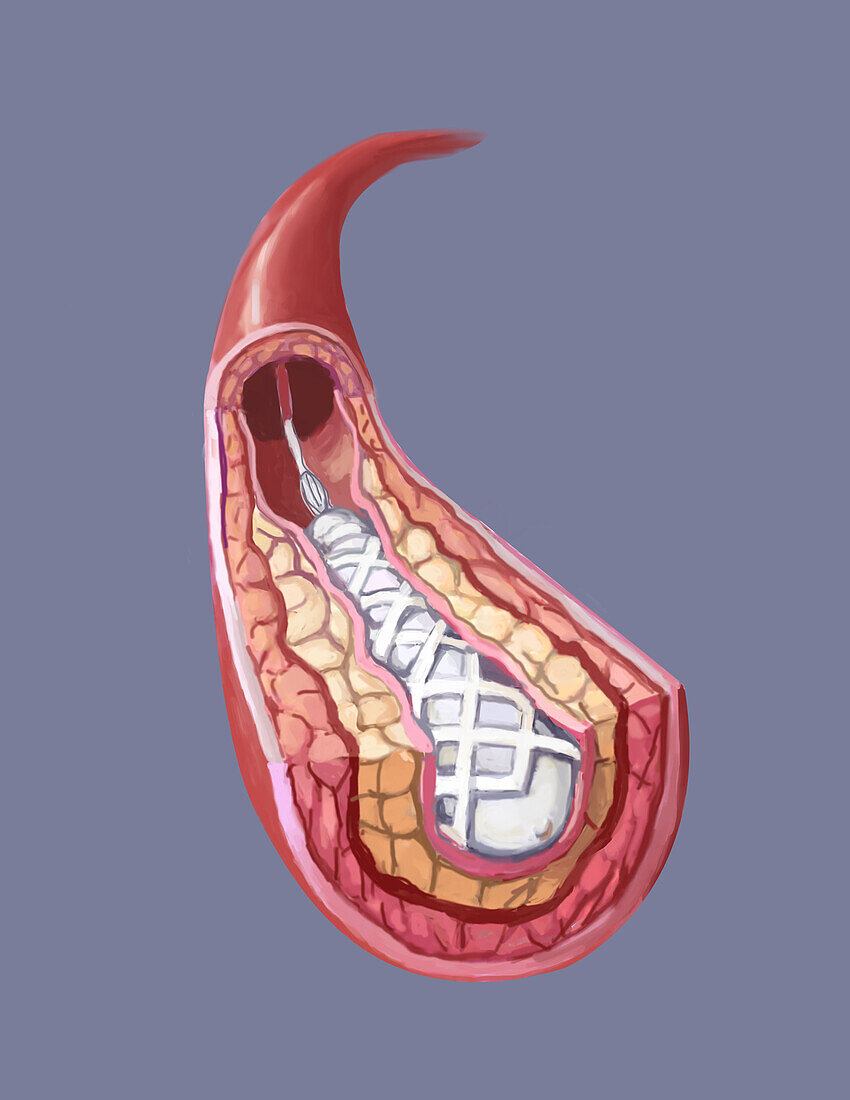 Clogged artery stent, illustration