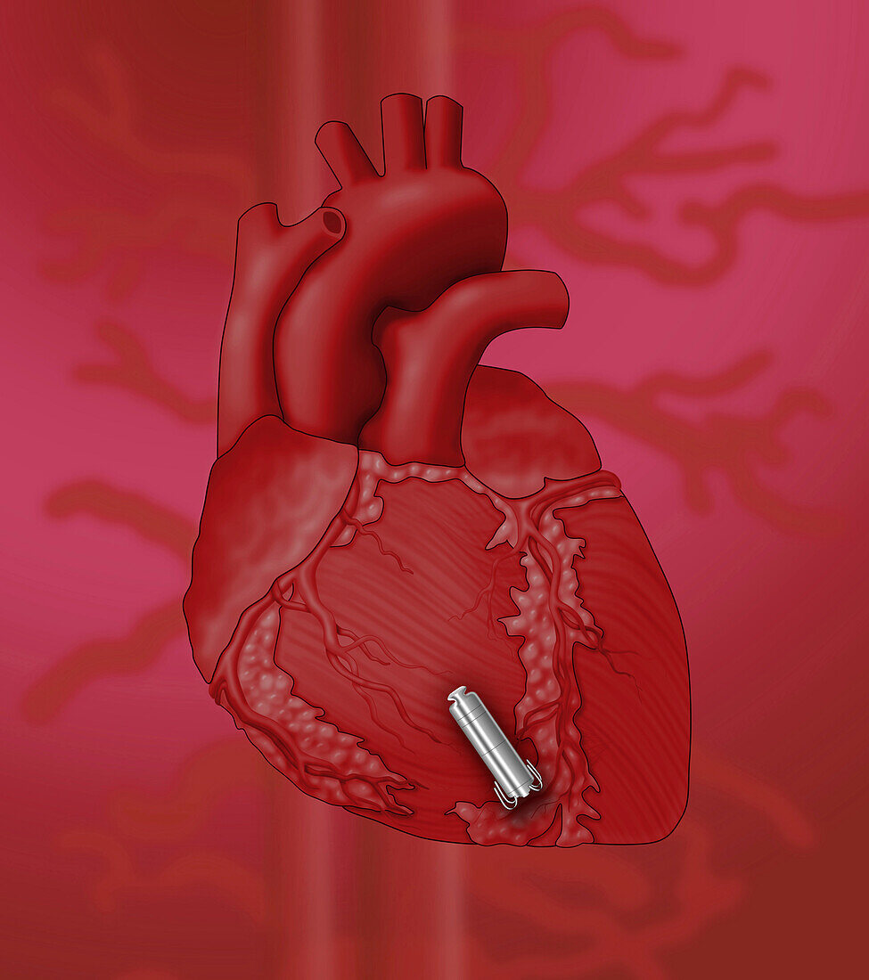Leadless pacemaker and heart, illustration
