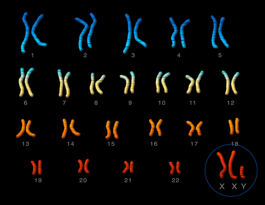 Klinefelter's syndrome karyotype, illustration