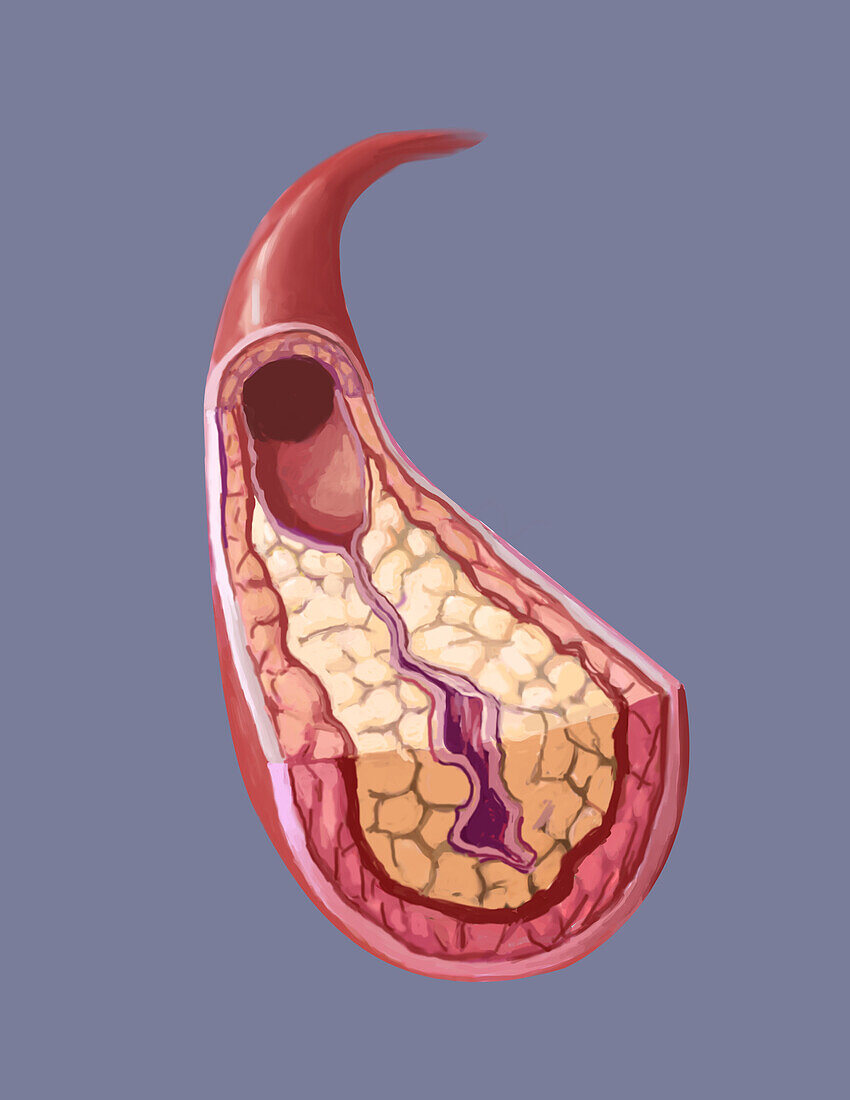 Clogged artery, illustration
