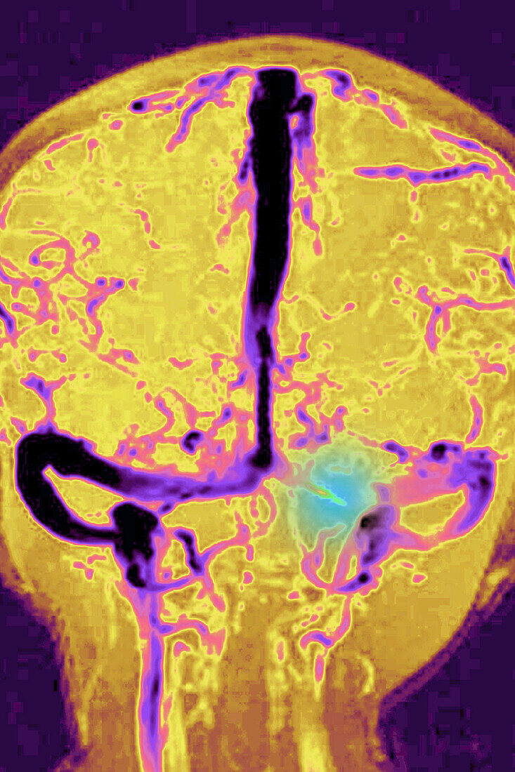 Cerebral venous thrombosis, MRA scan