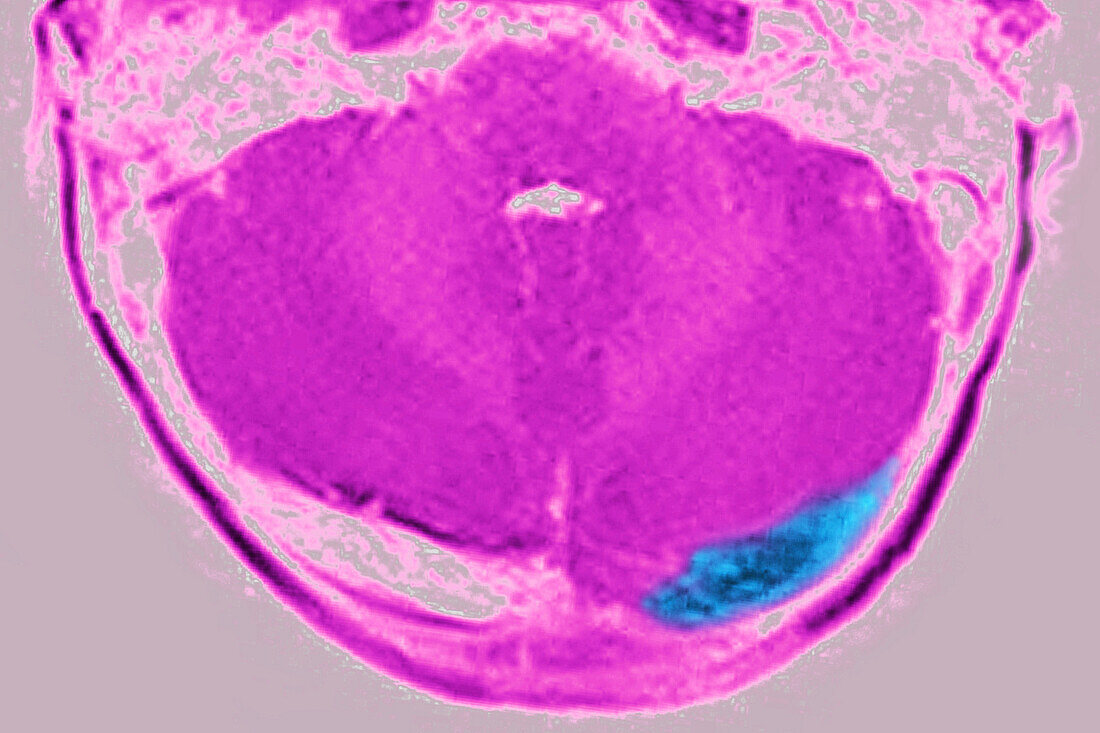 Cerebral venous thrombosis, MRI scan