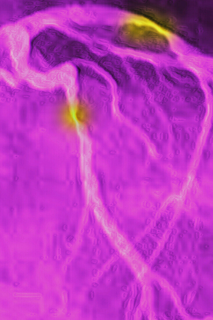 Myocardial infarction, angiography