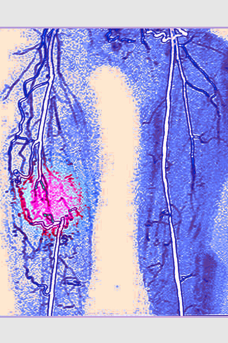 Thrombosis of iliac artery, MRA scan