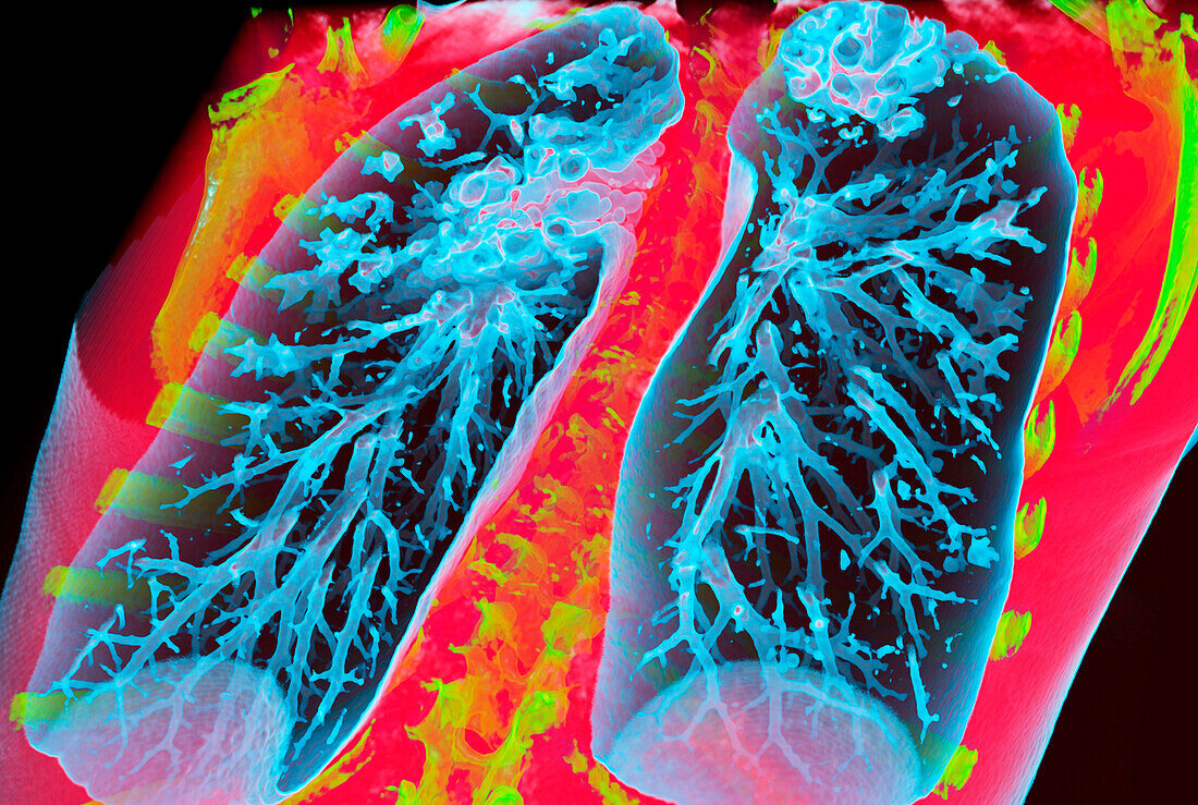 Bronchiectasis, 3D CT scan