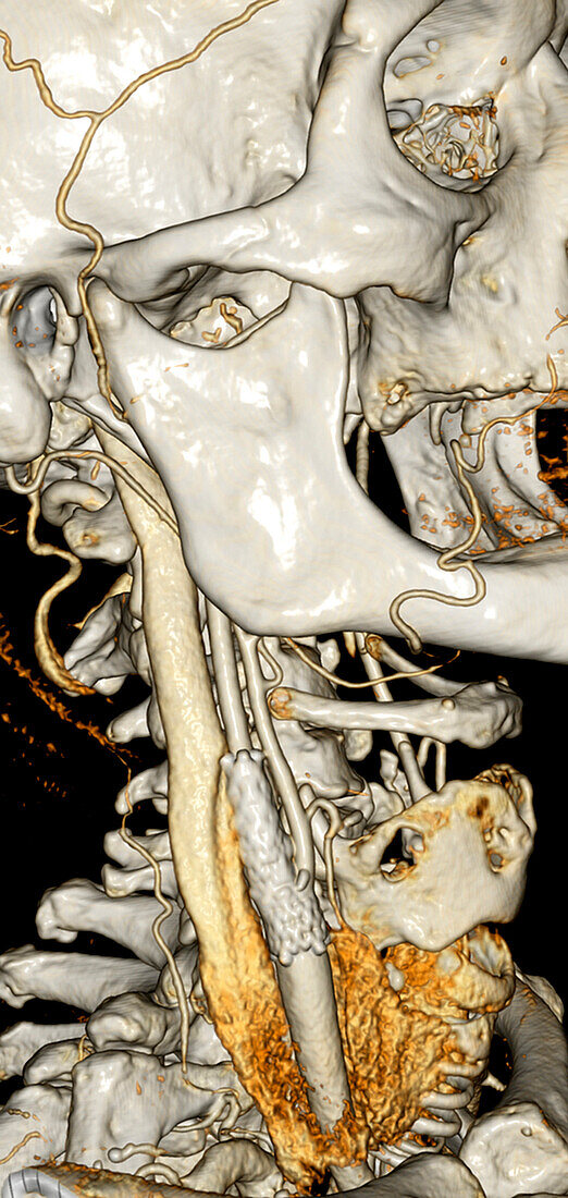 Arterial stent, 3D CT scan