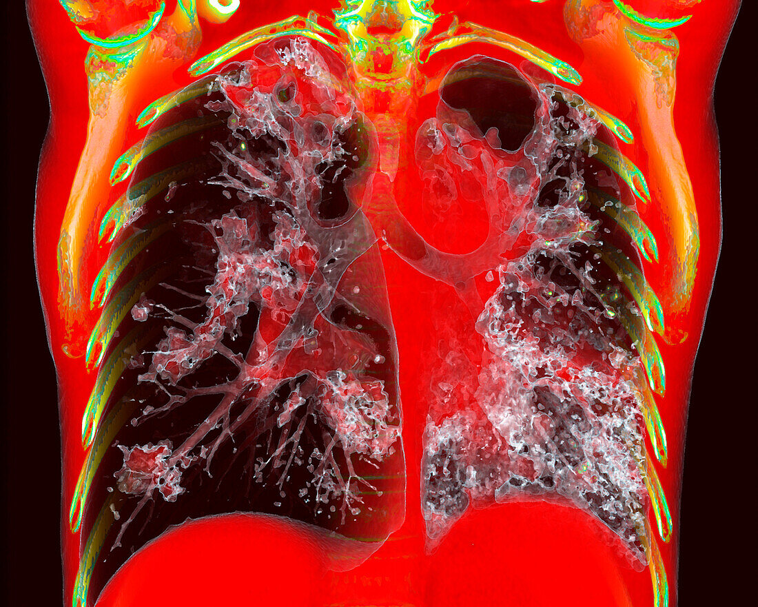 Tuberculosis, 3D CT scan